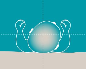 Plagiozephalie bei Säuglingen