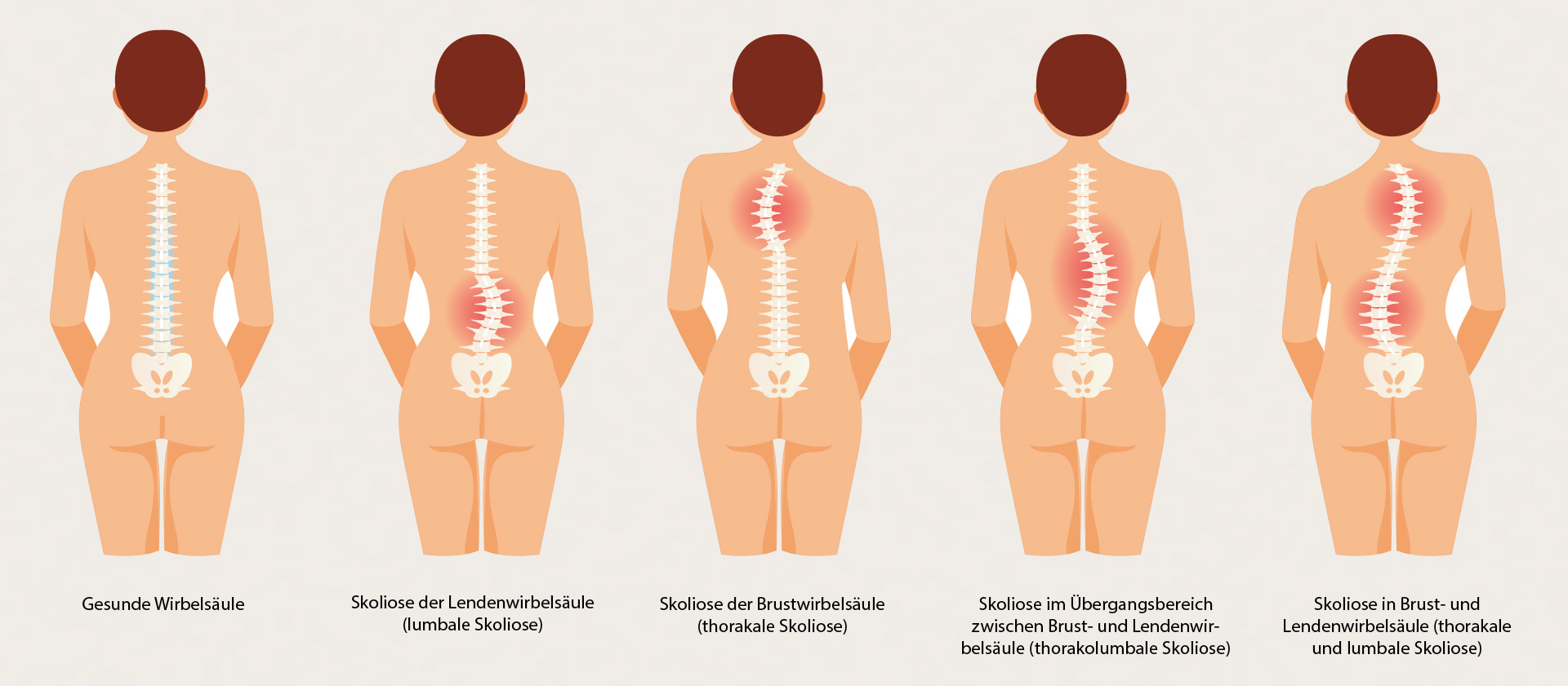verschiedene Skoliose-Typen